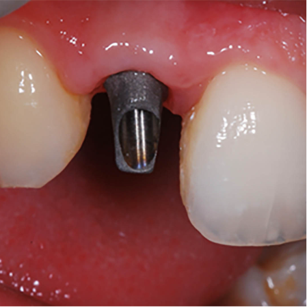 Dental Implants - The Dentist UK