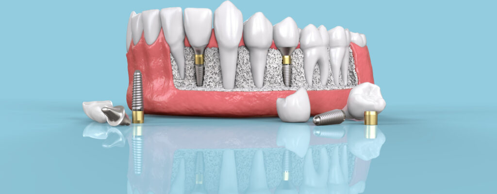 dental implants leeds